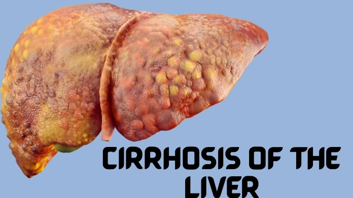 cirrhosis of the liver